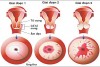 HPV gây ra ung thư gì?