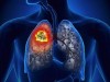 Ung thư phổi là gì? Ung thư phổi có lây không?