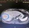 Điều trị bệnh nhân ung thư đại tràng sigma di căn gan đa ổ đáp ứng hoàn toàn tại BVUB Bắc Giang