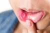 Những yếu tố nguy cơ và dấu hiệu nhận biết ung thư khoang miệng