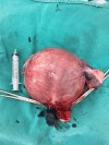 Bệnh viện Ung bướu Bắc Giang phẫu thuật cắt bỏ thành công khối  u xơ tử cung KT lớn 135x115x85mm