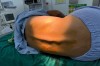 NHỮNG KHÓ KHĂN TRONG GÂY MÊ TỦY SỐNG