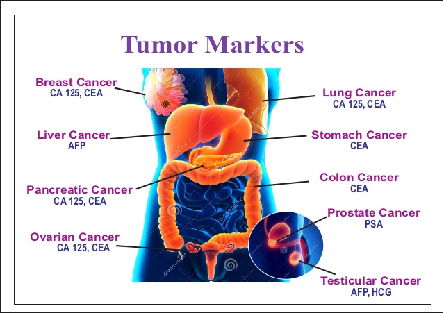 CEA- Một dấu ấn ung thư nhiều giá trị
