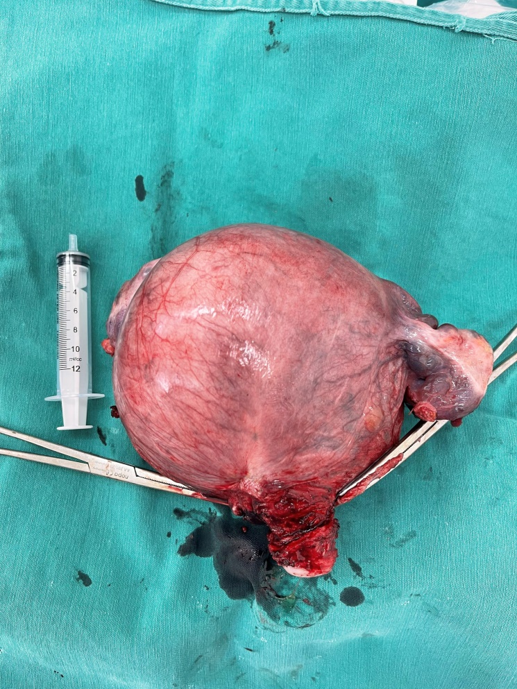 Bệnh viện Ung bướu Bắc Giang phẫu thuật cắt bỏ thành công khối  u xơ tử cung KT lớn 135x115x85mm