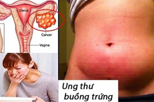 4. Triệu chứng của ung thư buồng trứng