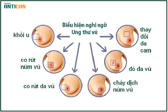 SÀNG LỌC SỚM UNG THƯ VÚ.