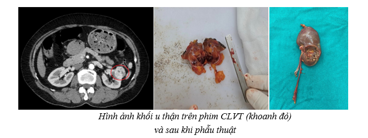 U Thận RCC: Triệu Chứng, Chẩn Đoán Và Các Phương Pháp Điều Trị Hiệu Quả