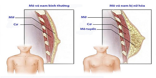 Bệnh Phì Đại Tuyến Vú: Nguyên Nhân, Triệu Chứng và Giải Pháp Điều Trị Hiệu Quả